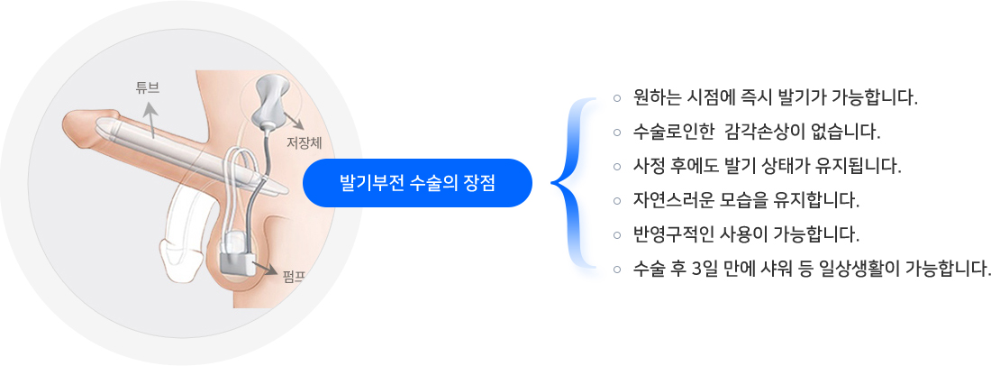 Advantages of Penile Implant Surgery