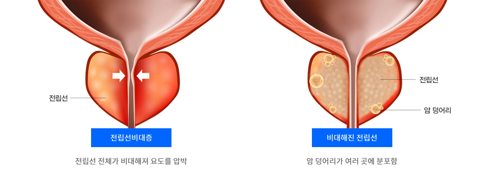 Prostate Cancer Symptoms
